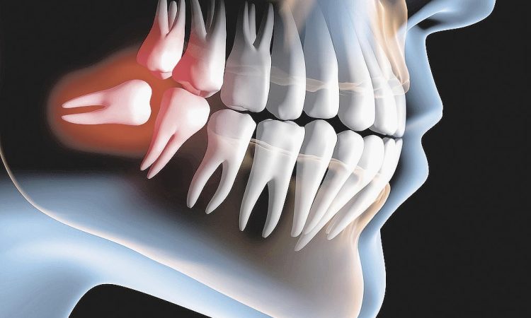cirurgia-de-siso-incluso-3