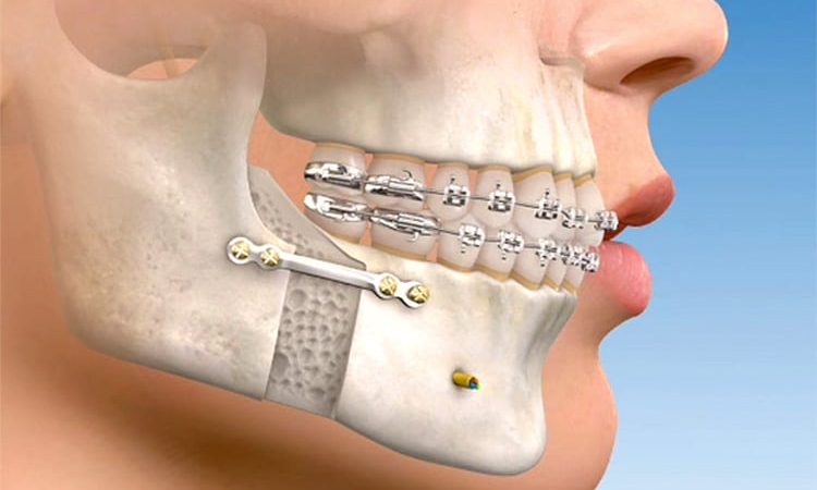 cirurgia-ortognatica